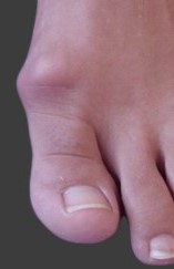 1437354689hallux_rigidus_big_toe_arthritis_1